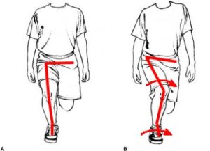 What's Causing My Hip Pain? - Physio Falmouth Plus