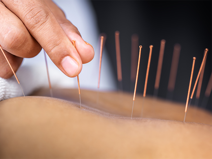 Could Acupuncture Help Me?